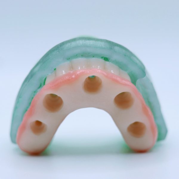 S3 Full Arch - Complete Full Arch Treatment - Image 8