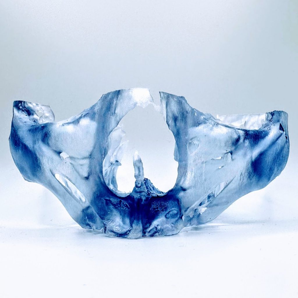 Upper Maxilla Model ONLY - Zygomatic Treatment