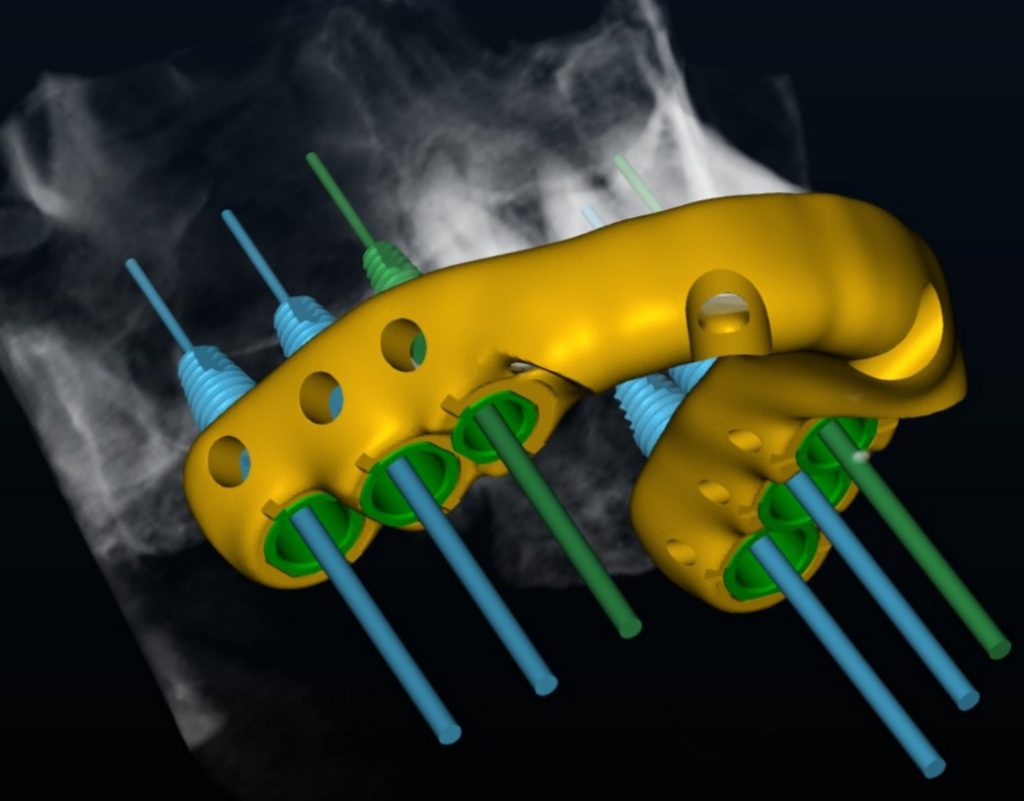 S2 Surgical Guide YOU PRINT / DIGITAL DESIGN ONLY - 4+ Implant Treatment