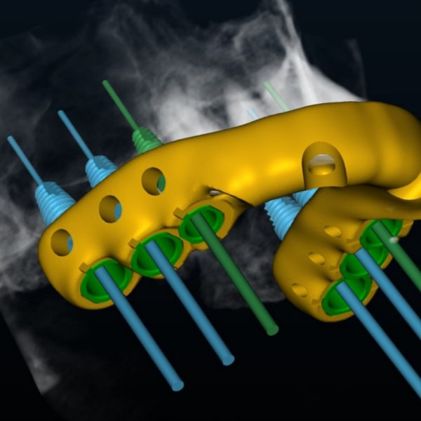 S2 Surgical Guide YOU PRINT / DIGITAL DESIGN ONLY - 4+ Implant Treatment