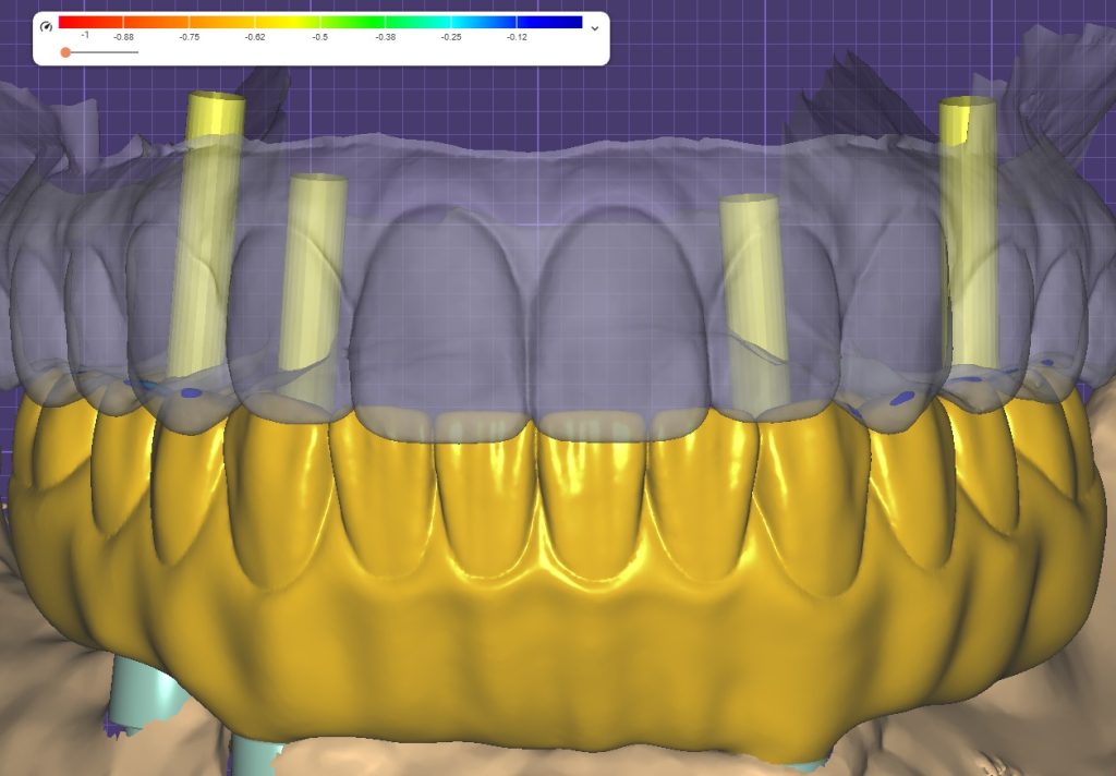 Same Day Smile Design