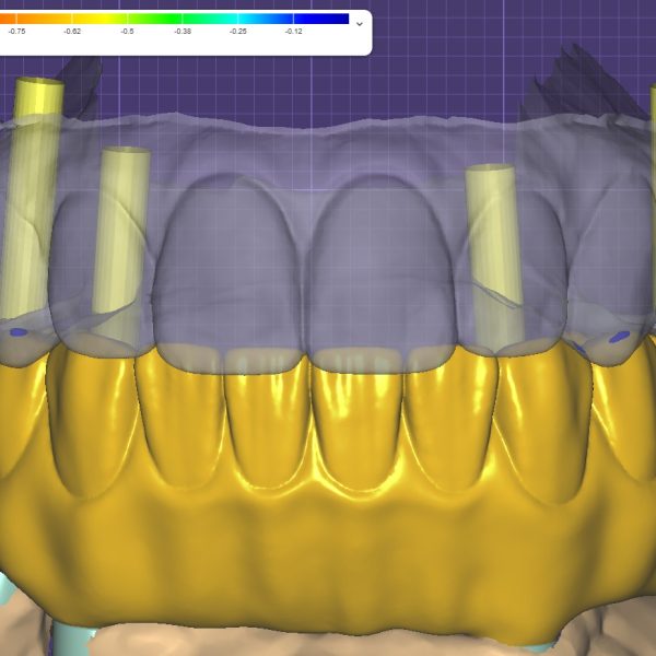 Same Day Smile Design