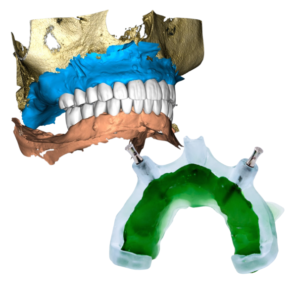 S3 Flex- Bone Reduction + Smile Design
